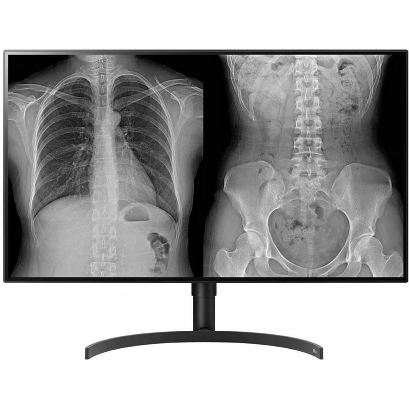 LG medical monitor displaying dual X-ray images with Picture by Picture functionality